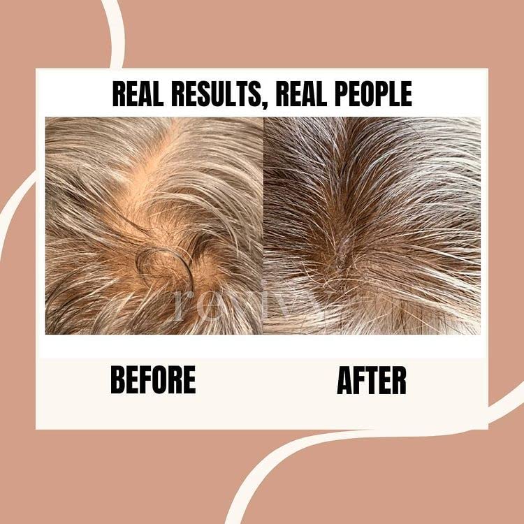 REVIVV Roller for Hair Rejuvenation – 0.25mm Roller for Scalp, Hair, Beard, Skin – 45 Day Supply